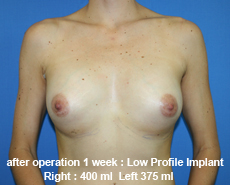 plastic-surgery-breast-augmentation